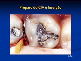 Preparo do CIV e inserção




                            SKB
 