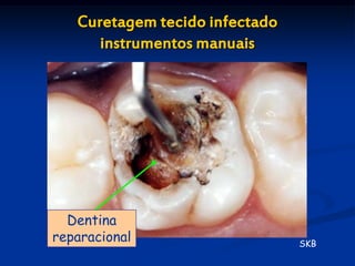 Curetagem tecido infectado
      instrumentos manuais




  Dentina
reparacional                    SKB
 
