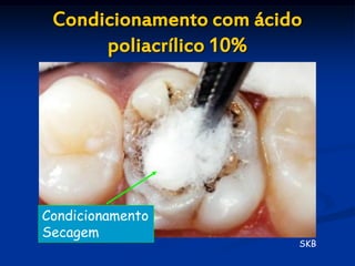 Condicionamento com ácido
      poliacrílico 10%




Condicionamento
Secagem
                         SKB
 