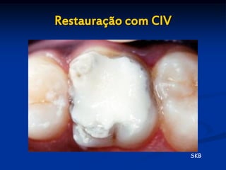 Restauração com CIV




                      SKB
 