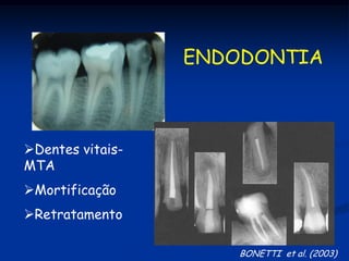 ENDODONTIA



Dentes vitais-
MTA
Mortificação
Retratamento

                      BONETTI et al. (2003)
 