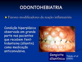 ODONTOHEBIATRIA
   Fatores modificadores da reação inflamatória

Condição hiperplásica
observada em grande
parte nos pacientes
que recebem fenil-
hidantoina (dilantin)
como medicação
anticonvulsiva.
                                Gengivite     Toledo et al.
                                dilantínica   (2002)
 