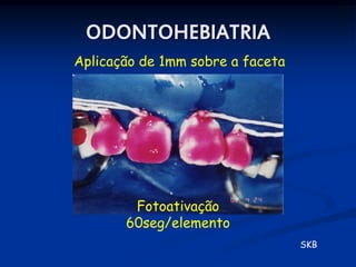 ODONTOHEBIATRIA
Aplicação de 1mm sobre a faceta




        Fotoativação
       60seg/elemento
                                  SKB
 