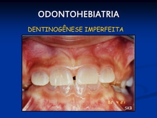 ODONTOHEBIATRIA
DENTINOGÊNESE IMPERFEITA




                           SKB
 