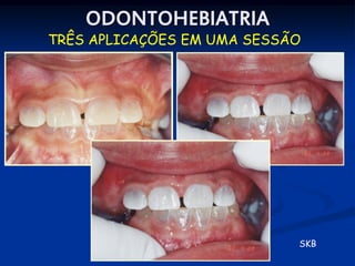 ODONTOHEBIATRIA
TRÊS APLICAÇÕES EM UMA SESSÃO




                            SKB
 
