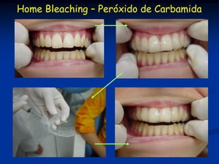 Home Bleaching – Peróxido de Carbamida
 