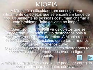 MIOPIA 
A Miopia é a dificuldade em conseguir ver 
nitidamente os objetos que se encontram longe de 
nós. Usualmente as pessoas costumam chamar a 
este problema "falta de vista ao longe". 
Quem sofre de Miopia vê os objetos que se 
encontram afastados muito desfocados pois a 
imagem forma-se antes da retina. A Miopia resulta 
da incapacidade do cristalino de se tornar menos 
convergente (menos curvo). 
O problema é corrigido com lentes divergentes (ou 
côncavas), como se pode observar na figura 
seguinte: 
A miopia ou falta de vista ao longe pode ser corrigida 
com a utilização de lentes côncavas 
 