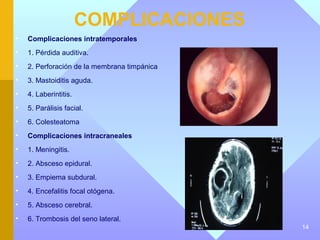 COMPLICACIONES
•   Complicaciones intratemporales
•   1. Pérdida auditiva.
•   2. Perforación de la membrana timpánica
•   3. Mastoiditis aguda.
•   4. Laberintitis.
•   5. Parálisis facial.
•   6. Colesteatoma
•   Complicaciones intracraneales
•   1. Meningitis.
•   2. Absceso epidural.
•   3. Empiema subdural.
•   4. Encefalitis focal otógena.
•   5. Absceso cerebral.
•   6. Trombosis del seno lateral.
                                              14
 