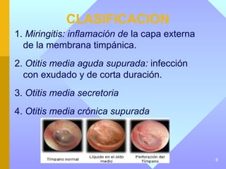 CLASIFICACION
1. Miringitis: inflamación de la capa externa
  de la membrana timpánica.
2. Otitis media aguda supurada: infección
  con exudado y de corta duración.
3. Otitis media secretoria
4. Otitis media crónica supurada




                                                6
 