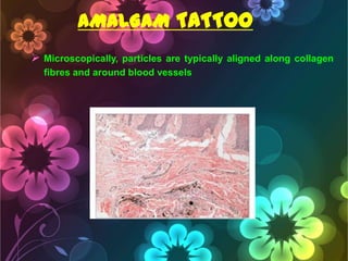 AMALGAM TATTOO
 Microscopically, particles are typically aligned along collagen
fibres and around blood vessels

 