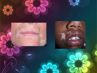 Oral Pigmentation