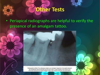 Other Tests
• Periapical radiographs are helpful to verify the
presence of an amalgam tattoo.

 