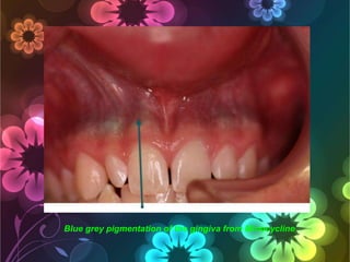 Blue grey pigmentation of the gingiva from Minocycline

 