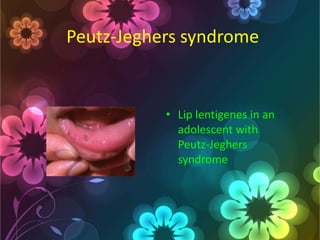 Peutz-Jeghers syndrome

• Lip lentigenes in an
adolescent with
Peutz-Jeghers
syndrome

 
