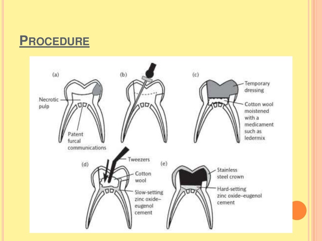 Difference between pulpotomy and pulpectomy