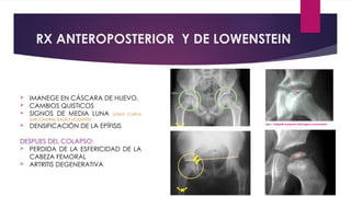 Lowenstein Rx Sindrome de Legg Calve Perthes. Diagnostico, manejo y tratamiento | PPTX