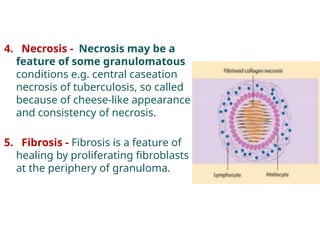 Caseation Cheese OP 6--CHRONIC INFLAMMATION in relation to oral cavity | PPTX