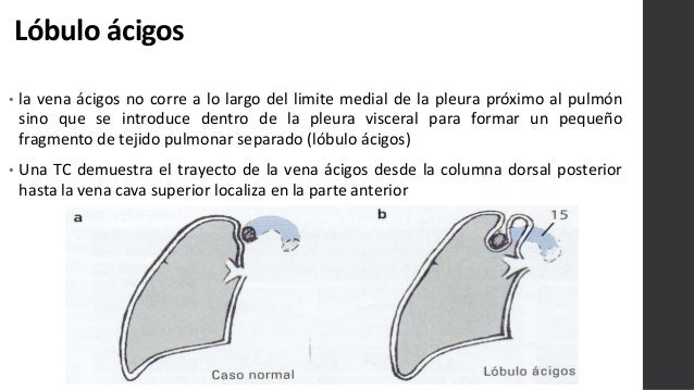 Opacidades focales revisado