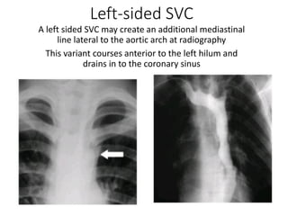 Comprehensive Overview of Pleural Thickening and Mediastinal Tumors ...