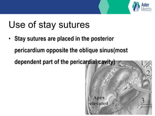 Use of stay sutures
• Stay sutures are placed in the posterior
pericardium opposite the oblique sinus(most
dependent part of the pericardial cavity)
 