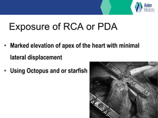 Exposure of RCA or PDA
• Marked elevation of apex of the heart with minimal
lateral displacement
• Using Octopus and or starfish
 