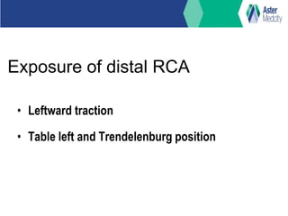 Exposure of distal RCA
• Leftward traction
• Table left and Trendelenburg position
 