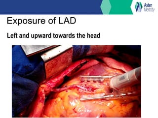 Exposure of LAD
Left and upward towards the head
 