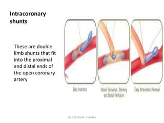 Intracoronary
shunts
These are double
limb shunts that fit
into the proximal
and distal ends of
the open coronary
artery
DR GEETANJALI S VERMA
 
