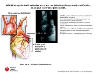OPCAB in a patient with extensive aortic and carotid artery atherosclerotic calcification,
analogous to our case presentation.
Verma S et al. Circulation. 2004;109:1206-1211
Copyright © American Heart Association, Inc. All rights reserved.
OPCAB in a patient with extensive aortic and carotid artery
atherosclerotic calcification,
In this patient, complete arterial revascularization was
performed using the OPCAB technology
without aortic manipulation, cannulation, or proximal
anastomosis.
The left internal thoracic artery (LITA) was anastomosed to
the LAD,
with a free radial T graft from the LITA anastomosed to both
the second obtuse marginal and posterior descending
branches.
An angiogram showing a radial T graft appears to the right.
 