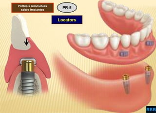 OPCIONES PROTÉSICAS EN IMPLANTOLOGÍA ORAL | PPTX