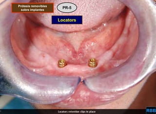 OPCIONES PROTÉSICAS EN IMPLANTOLOGÍA ORAL | PPTX