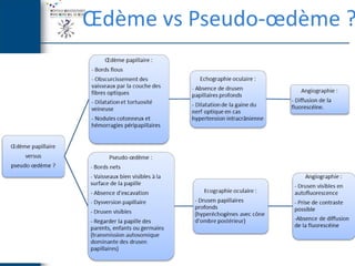 [DES1 Urgences] Oedeme papillaire / Dr C.Lamirel (23 mars 2013) | PDF