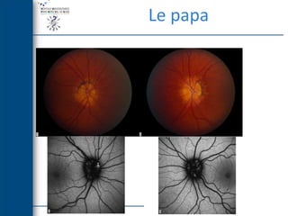 [DES1 Urgences] Oedeme papillaire / Dr C.Lamirel (23 mars 2013) | PDF