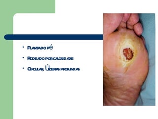 Planta do pé Rodeado por calosidade Circular, Úlceras profundas 