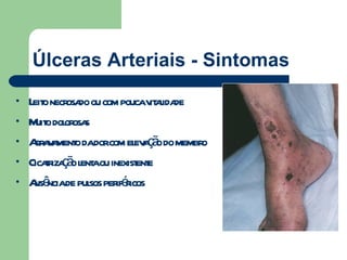 Úlceras Arteriais - Sintomas Leito necrosado ou com pouca vitalidade Muito dolorosas Agravamento da dor com elevação do membro Cicatrização lenta ou inexistente Ausência de pulsos periféricos 