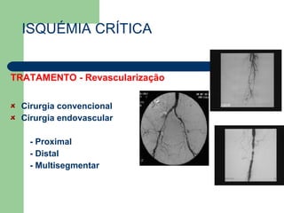 ISQUÉMIA CRÍTICA TRATAMENTO - Revascularização Cirurgia convencional Cirurgia endovascular - Proximal - Distal - Multisegmentar 