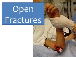 Open
Fractures
 