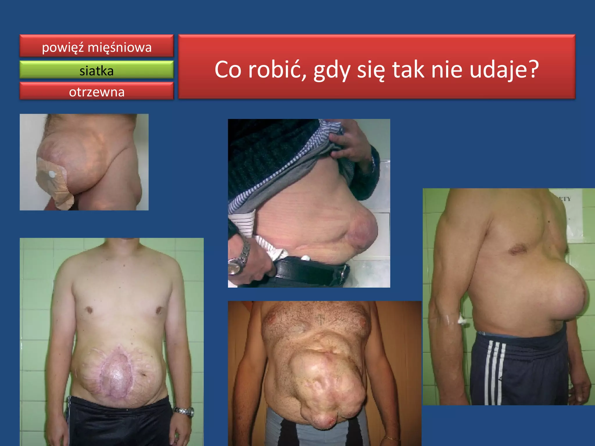 Open ipom ventral hernia repair ppt