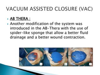  AB THERA :
 Another modification of the system was
introduced in the AB-Thera with the use of
spider-like sponge that allow a better fluid
drainage and a better wound contraction.
 