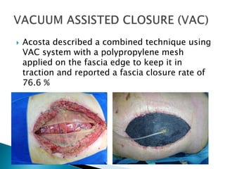  Acosta described a combined technique using
VAC system with a polypropylene mesh
applied on the fascia edge to keep it in
traction and reported a fascia closure rate of
76.6 %
 