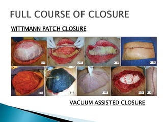 WITTMANN PATCH CLOSURE
VACUUM ASSISTED CLOSURE
 