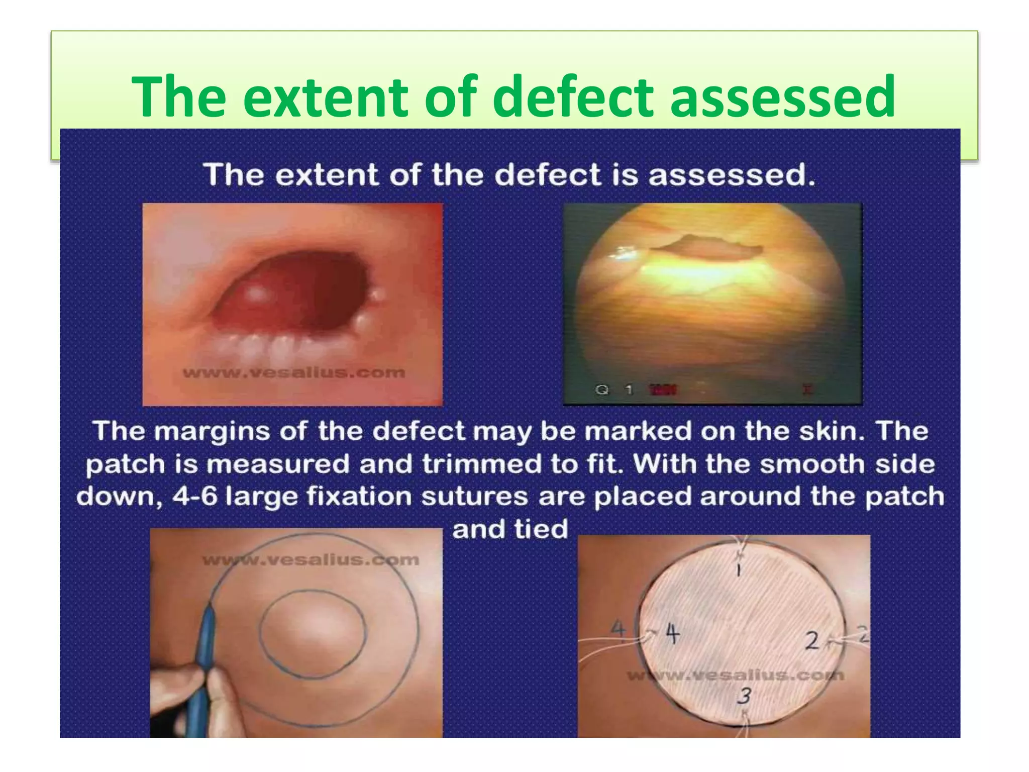 Open and laproscopic repair of incisional hernia | PPTX