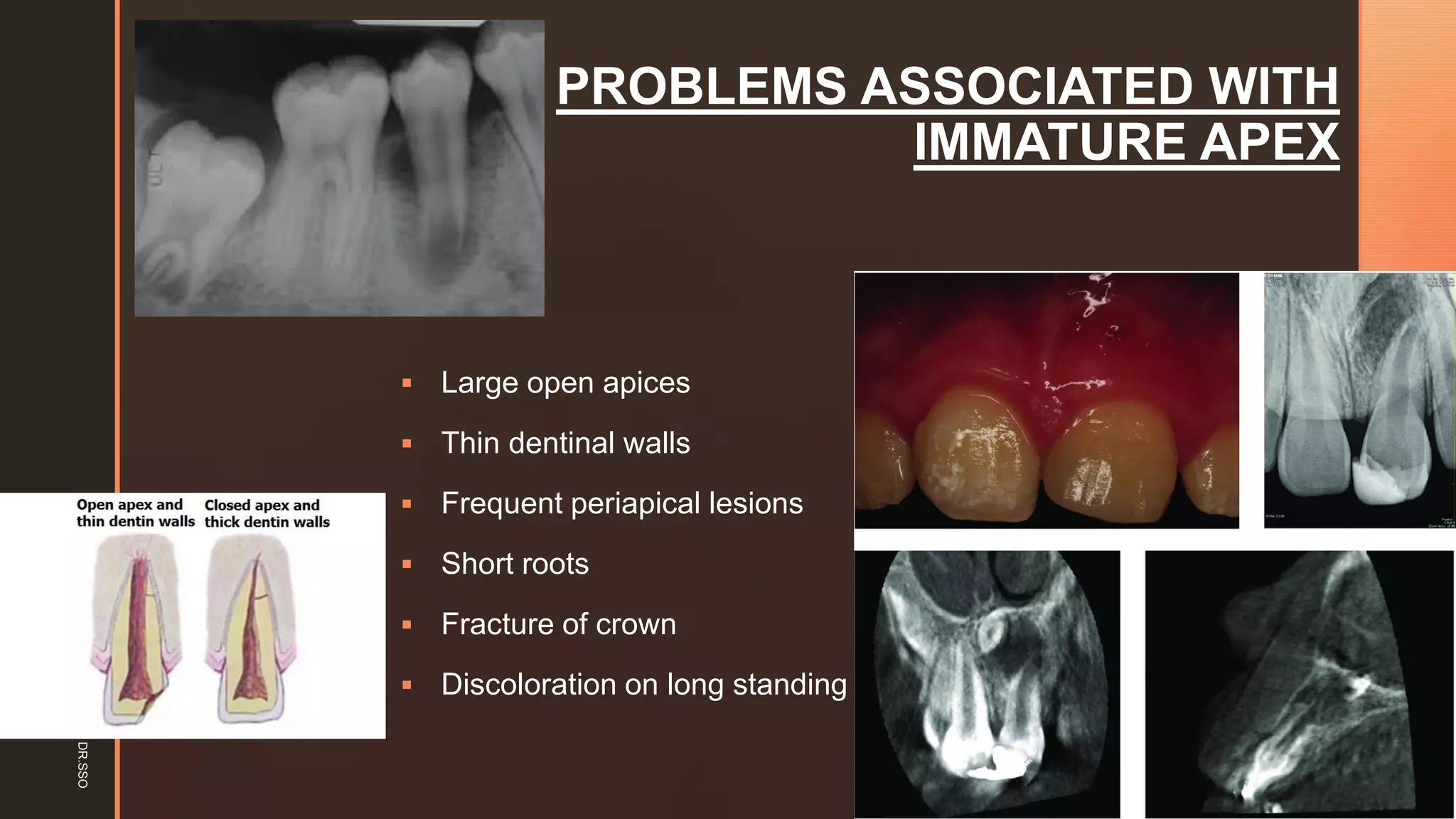 z PROBLEMS ASSOCIATED WITH
IMMATURE APEX
▪ Large open apices
▪ Thin dentinal walls
▪ Frequent periapical lesions
▪ Short roots
▪ Fracture of crown
▪ Discoloration on long standing
DR.SSO
 