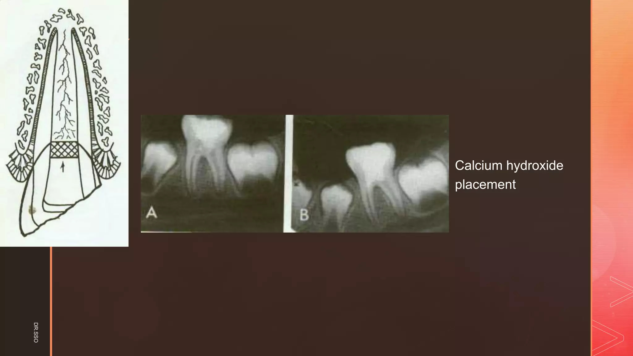 z
▪ Calcium hydroxide
placement
DR.SSO
 