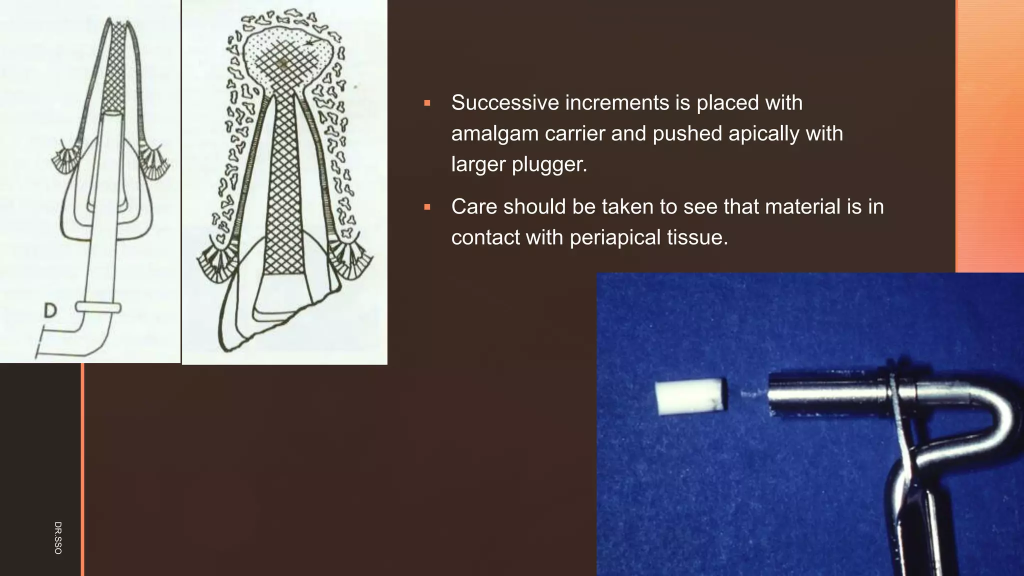 z
▪ Successive increments is placed with
amalgam carrier and pushed apically with
larger plugger.
▪ Care should be taken to see that material is in
contact with periapical tissue.
DR.SSO
 