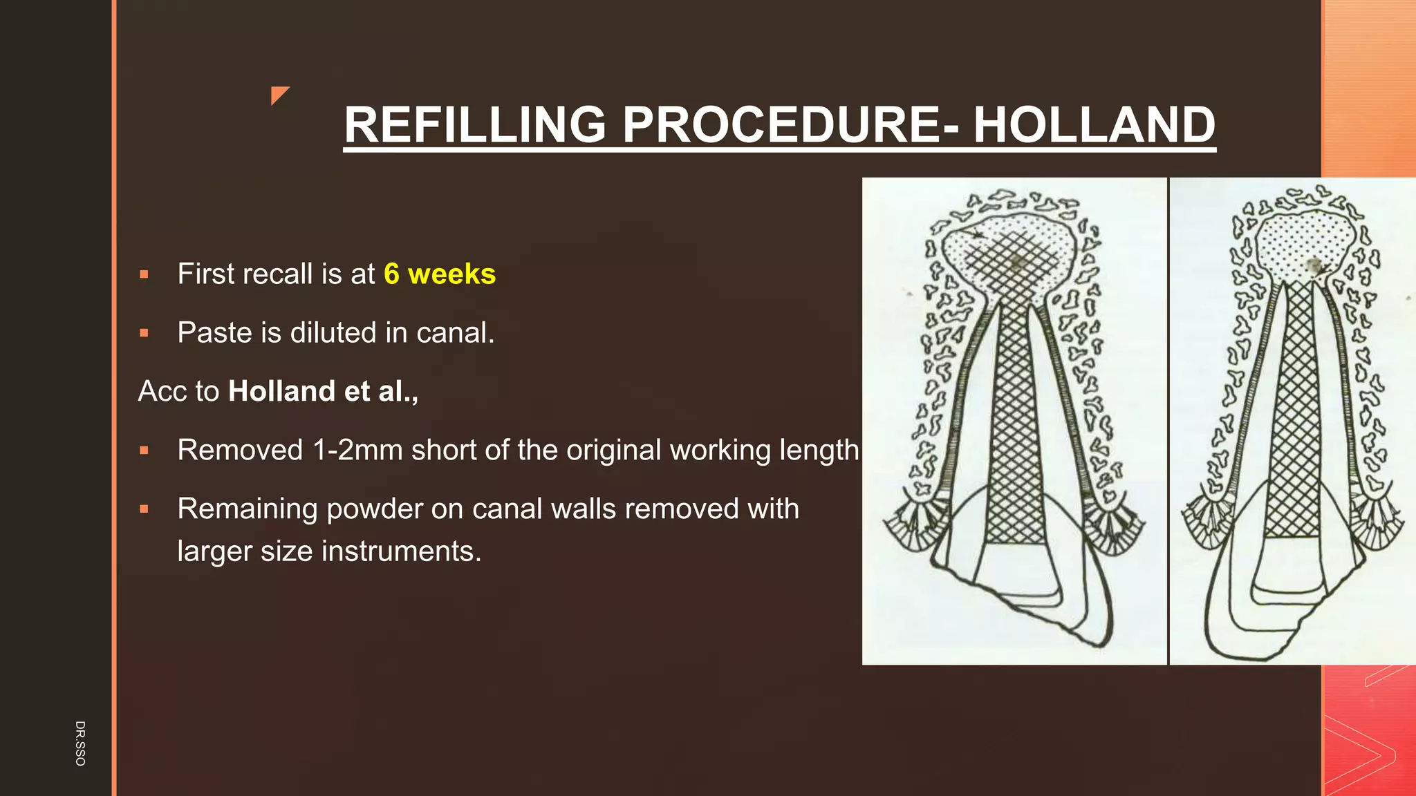 z
REFILLING PROCEDURE- HOLLAND
▪ First recall is at 6 weeks
▪ Paste is diluted in canal.
Acc to Holland et al.,
▪ Removed 1-2mm short of the original working length
▪ Remaining powder on canal walls removed with
larger size instruments.
DR.SSO
 