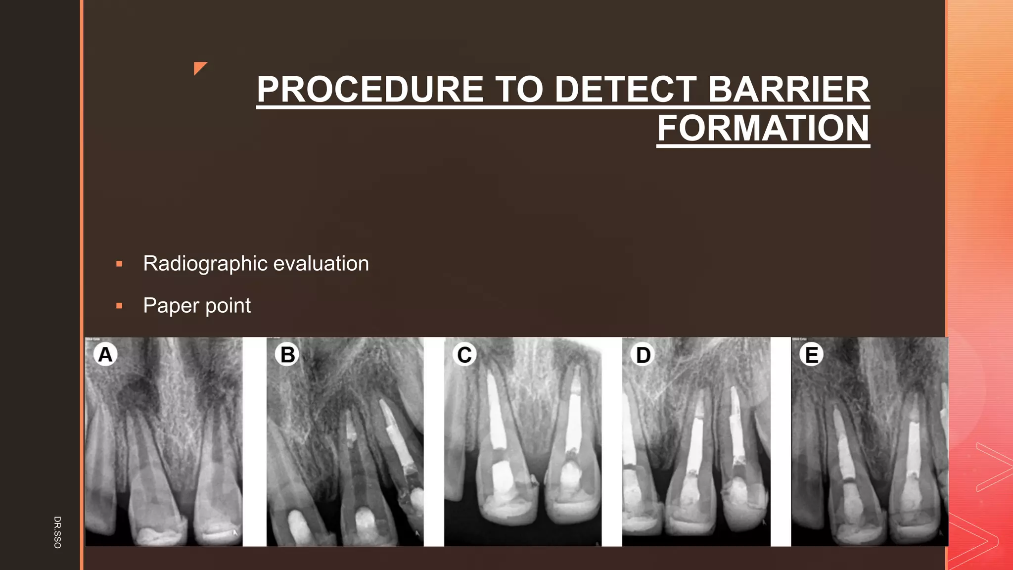 z
PROCEDURE TO DETECT BARRIER
FORMATION
▪ Radiographic evaluation
▪ Paper point
DR.SSO
 