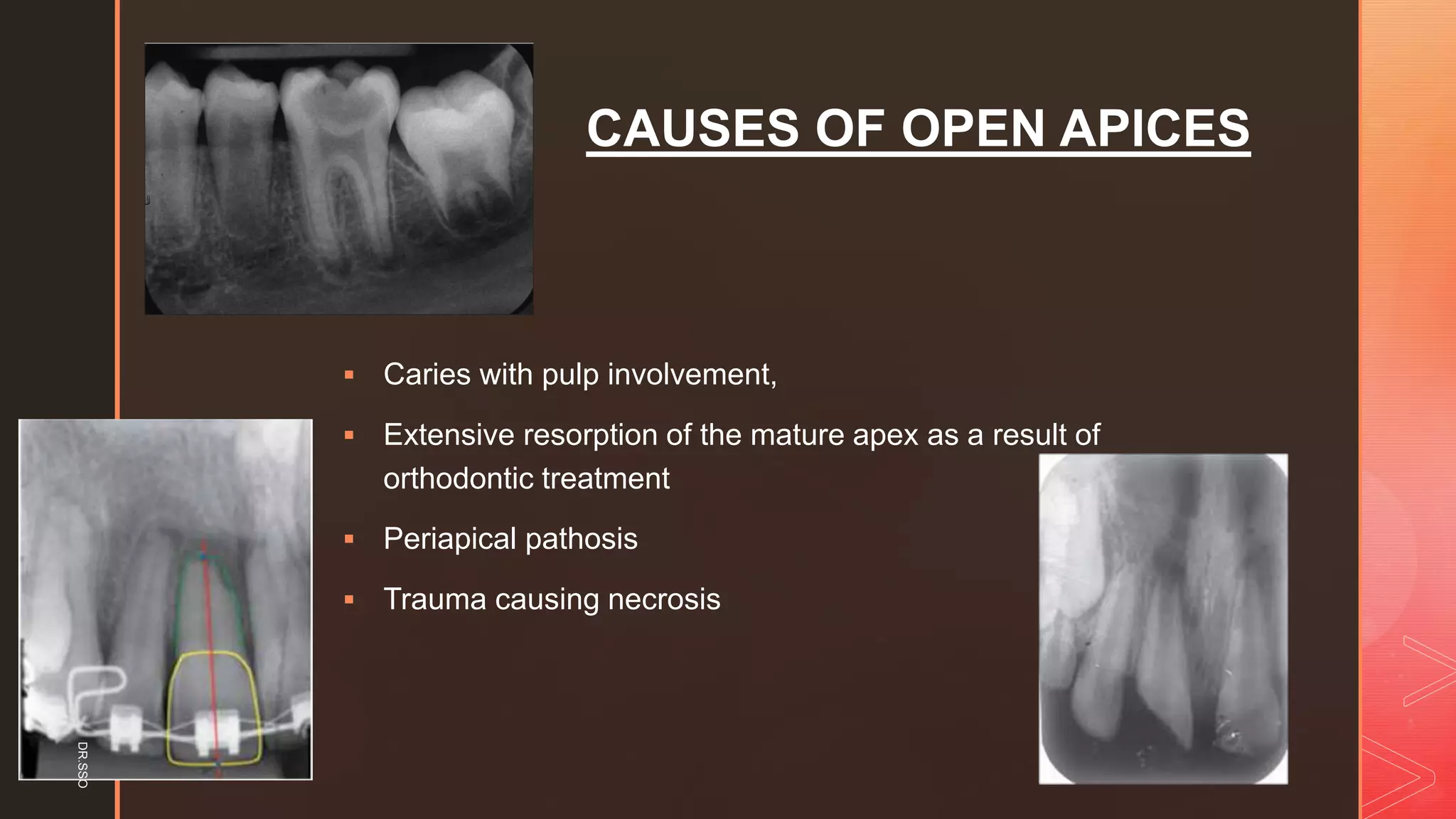 z
CAUSES OF OPEN APICES
▪ Caries with pulp involvement,
▪ Extensive resorption of the mature apex as a result of
orthodontic treatment
▪ Periapical pathosis
▪ Trauma causing necrosis
DR.SSO
 