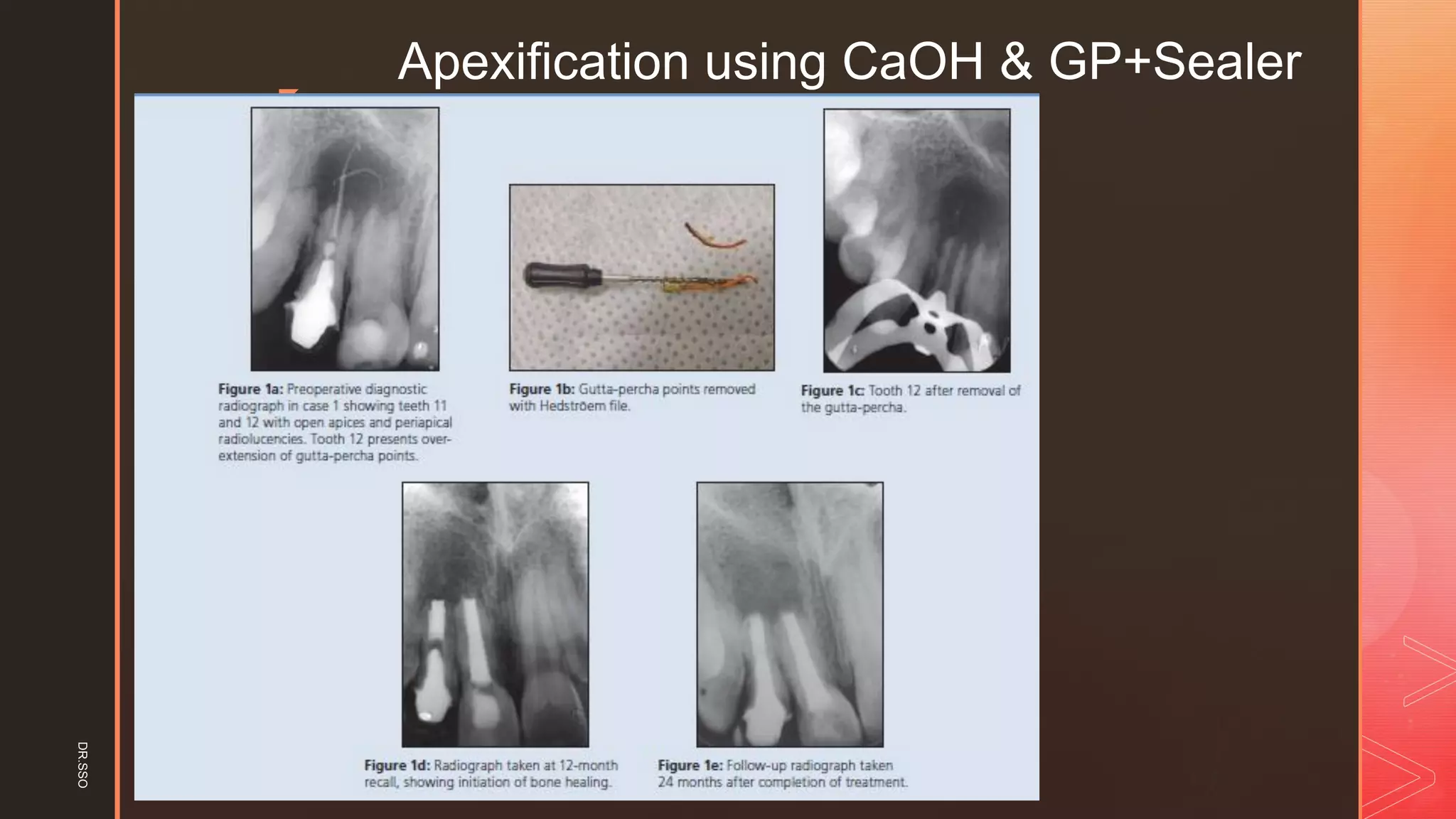 z
Apexification using CaOH & GP+SealerDR.SSO
 