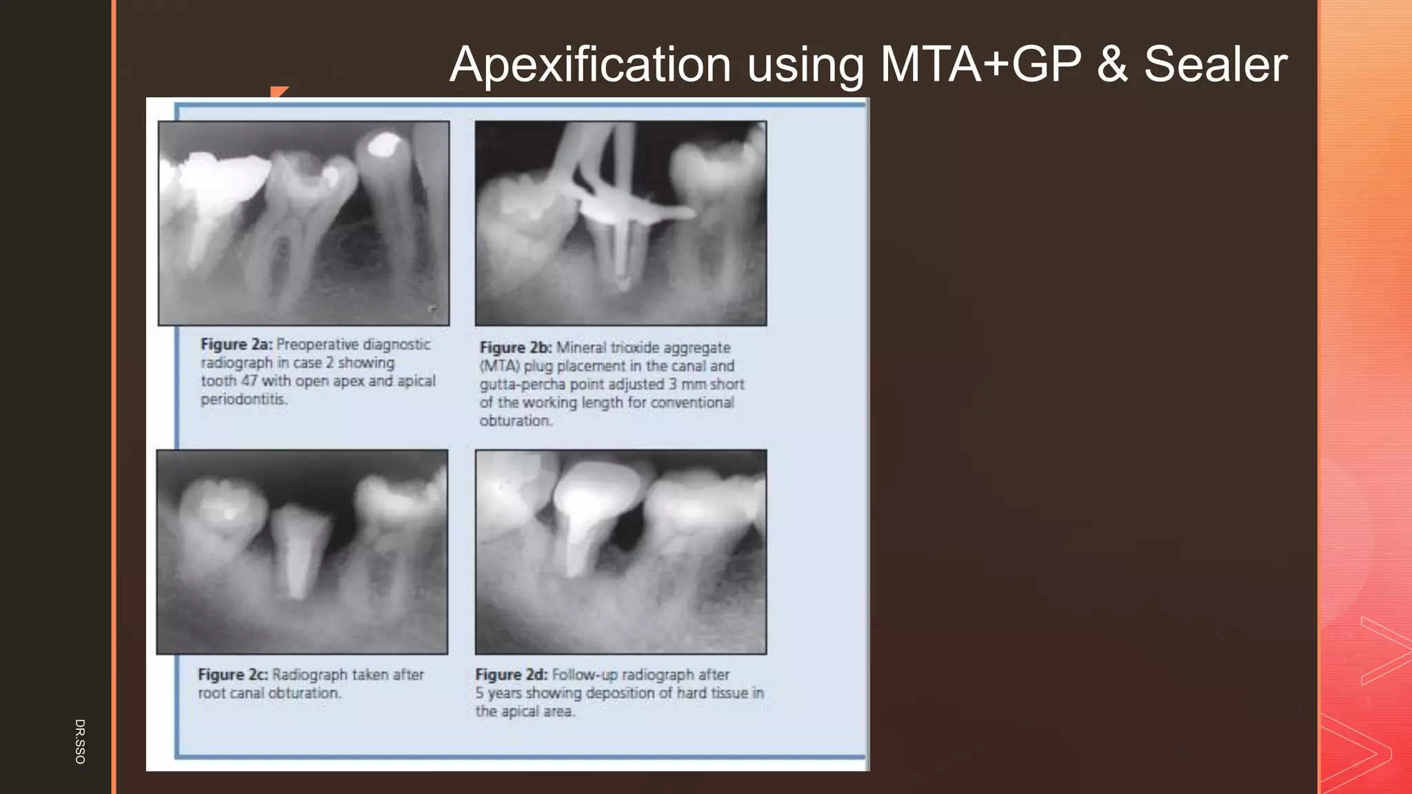 z
Apexification using MTA+GP & SealerDR.SSO
 
